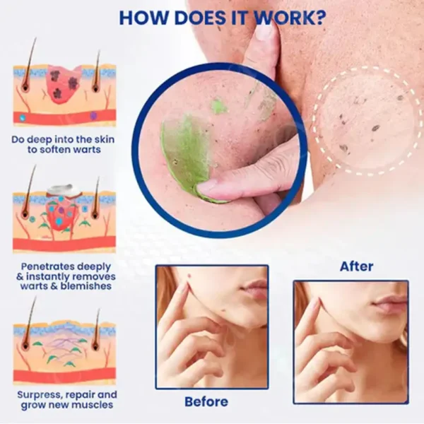 ✅ Official Store: Femica™ NatureErase Instant Mole & Spot Cream