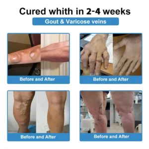 ✅ official store💎Grunsify™ Nano👩‍⚕️(COA) Recommended microneedle joint patch (painless, long-lasting, suitable for arthritis varicose veins and various orthopedic disease）