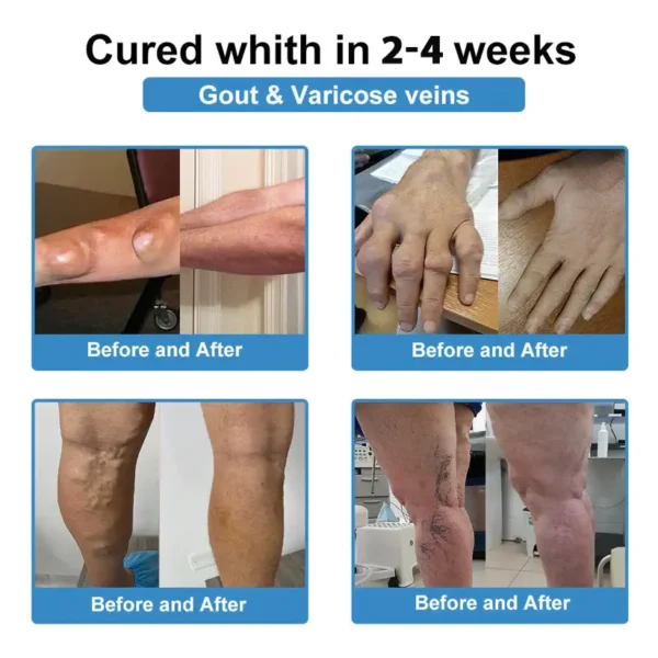 ✅ official store💎Grunsify™ Nano👩‍⚕️(COA) Recommended microneedle joint patch (painless, long-lasting, suitable for arthritis varicose veins and various orthopedic disease）