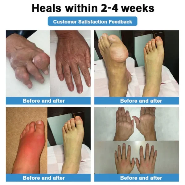 ✅ official store💎Grunsify™ Nano👩‍⚕️(COA) Recommended microneedle joint patch (painless, long-lasting, suitable for arthritis varicose veins and various orthopedic disease）