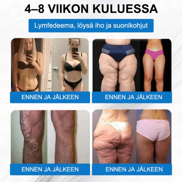 ZVOEVO® SMGT-GLP-1 𝐓𝐢𝐫𝐳𝐞𝐧𝐬𝐭𝐢 & Kollageeni Nano-Mikroneula Laihdutuslaastari