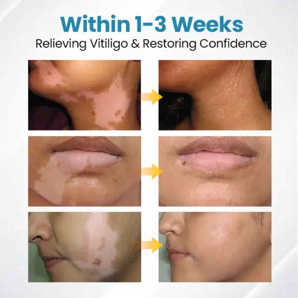 Bikenda® DermaBeam Vitiligo Therapy Device