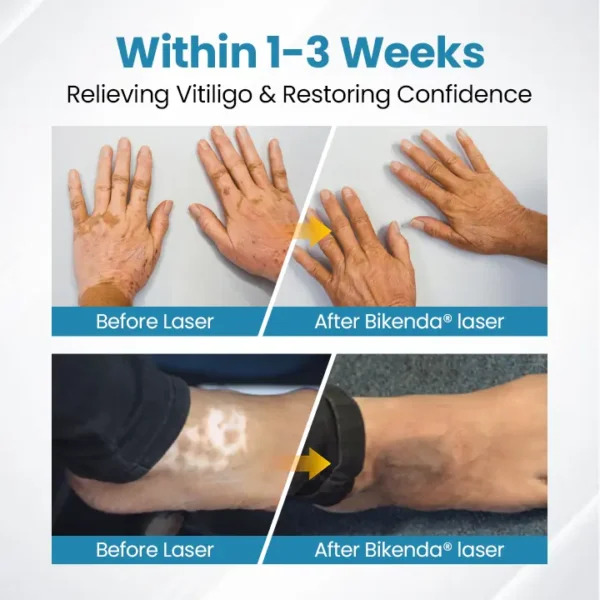 Bikenda® DermaBeam Vitiligo Therapy Device