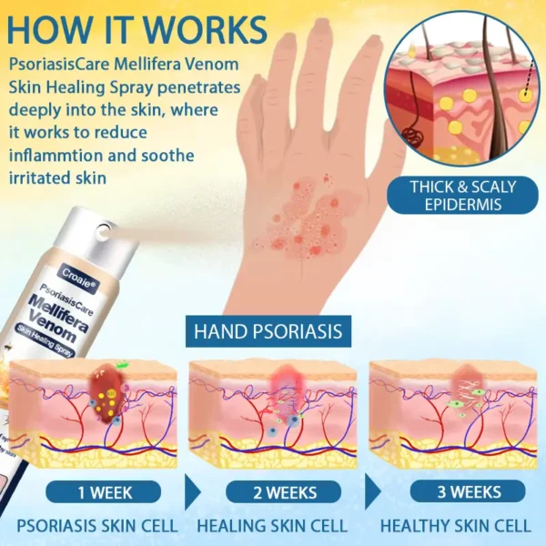 Croaie® PsoriasisCare Mellifera Venom Skin Healing Spray
