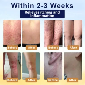 Croaie® PsoriasisCare Mellifera Venom Skin Healing Spray