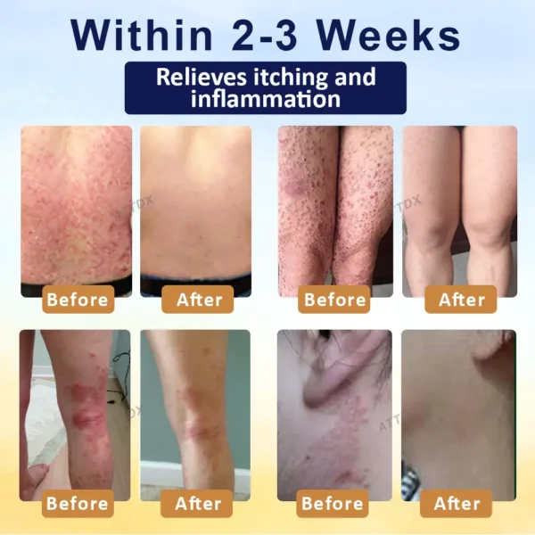 Croaie® PsoriasisCare Mellifera Venom Skin Healing Spray