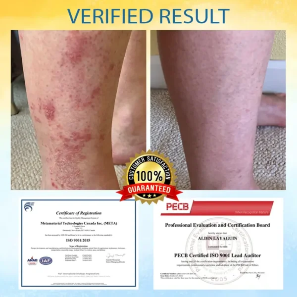Croaie® PsoriasisCare Mellifera Venom Skin Healing Spray
