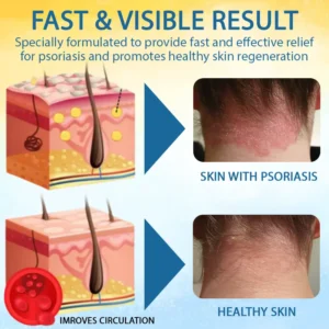 Croaie® PsoriasisCare Mellifera Venom Skin Healing Spray