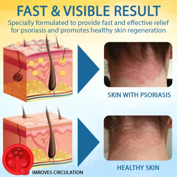 Croaie® PsoriasisCare Mellifera Venom Skin Healing Spray