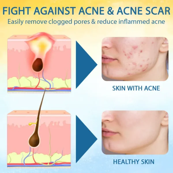Croaie® PsoriasisCare Mellifera Venom Skin Healing Spray