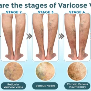 GFOUK® VenaRestore MicroNeedle Vein Repair Patch