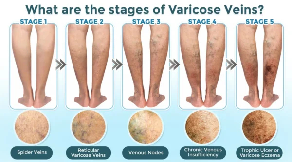GFOUK® VenaRestore MicroNeedle Vein Repair Patch