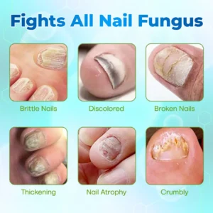 Lbmlbm® OnyxiGuard Fungal Repair Herbal Spray – 🌿 Natural Treatment for Healthy, Revitalized Skin & Nails ✨