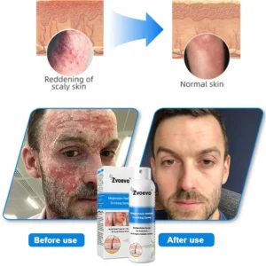 ✅Official Store: Zvoevo®Magnesium Herbal Spray⚕️FDA certified (Relief for Psoriasis and Eczema, Improvement of Bacterial Infections in the Genital Area, and Treatment of Acne and Dark Spots)