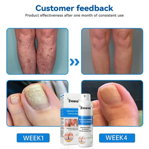 ✅Official Store: Zvoevo®Magnesium Herbal Spray⚕️FDA certified (Relief for Psoriasis and Eczema, Improvement of Bacterial Infections in the Genital Area, and Treatment of Acne and Dark Spots)
