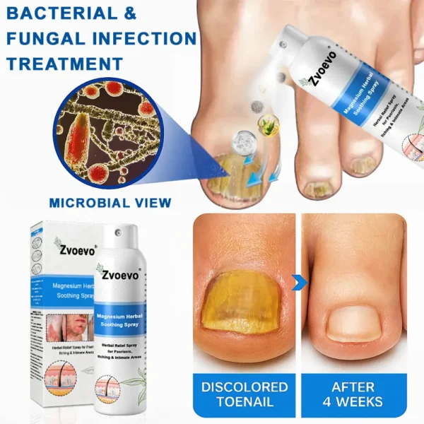 ✅Official Store: Zvoevo®Magnesium Herbal Spray⚕️FDA certified (Relief for Psoriasis and Eczema, Improvement of Bacterial Infections in the Genital Area, and Treatment of Acne and Dark Spots)