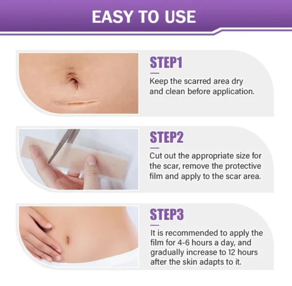 ✅Official Store |Newyuo® Skin plumping formula Nano Microneedle Repair Tape🏥(Treatment of old and new scars, reduction of surgical scars, stretch marks, keloids, acne, burns, warts, dermatomes and varicose veins)