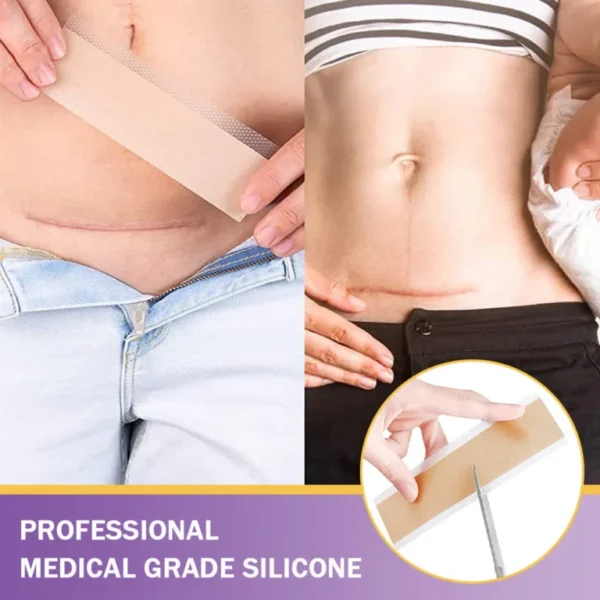 ✅Official Store |Newyuo® Skin plumping formula Nano Microneedle Repair Tape🏥(Treatment of old and new scars, reduction of surgical scars, stretch marks, keloids, acne, burns, warts, dermatomes and varicose veins)