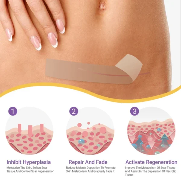 ✅Official Store |Newyuo® Skin plumping formula Nano Microneedle Repair Tape🏥(Treatment of old and new scars, reduction of surgical scars, stretch marks, keloids, acne, burns, warts, dermatomes and varicose veins)