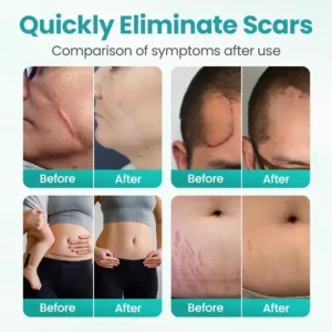 BBOJI® EliteAloe ScarSolve Spray