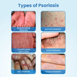 BBOJI® MagnesiumHerb Psoriasis Relief Cream
