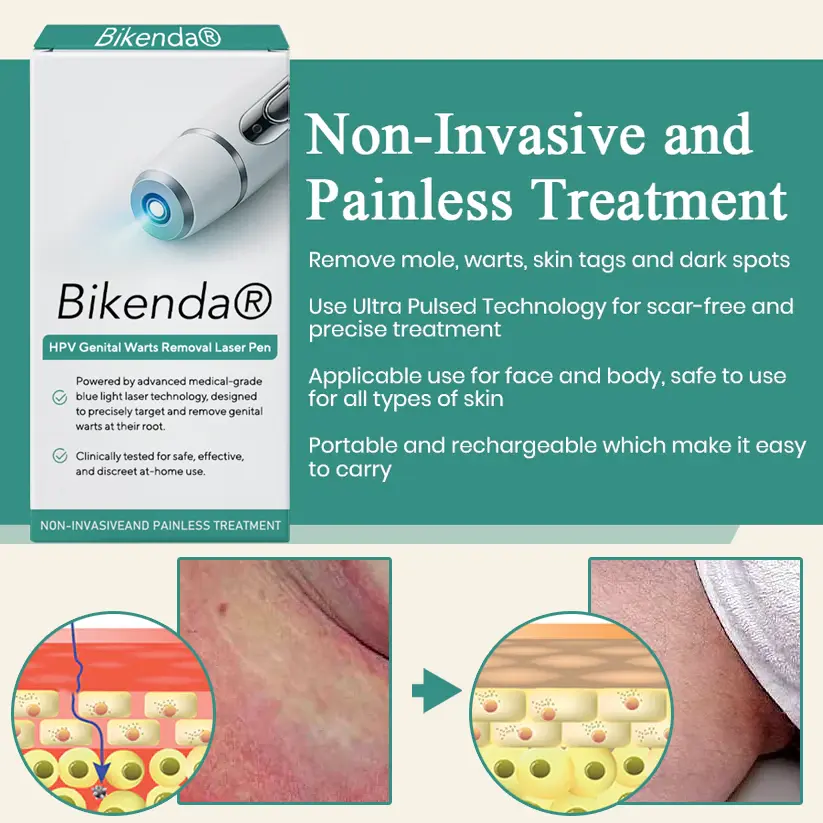 Bikenda® HPV ULTRA Genital Warts Removal Laser Pen