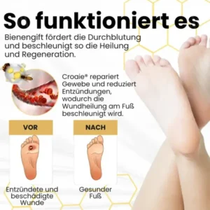 Croaie® Bienengift Spray für Diabetische Fußgeschwüre✔𝐬𝐢𝐜𝐡𝐭𝐛𝐚𝐫𝐞 𝐕𝐞𝐫𝐛𝐞𝐬𝐬𝐞𝐫𝐮𝐧𝐠 𝐢𝐧 𝟐-𝟑 𝐖𝐨𝐜𝐡𝐞𝐧✔