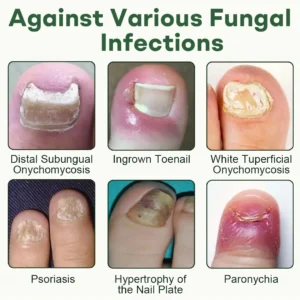 Dobshow® Nail Fungus Renewal Gel