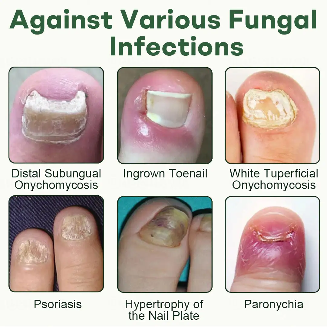 Dobshow® Nail Fungus Renewal Gel