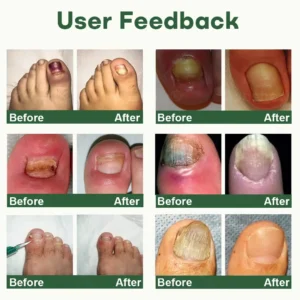 Dobshow® Nail Fungus Renewal Gel