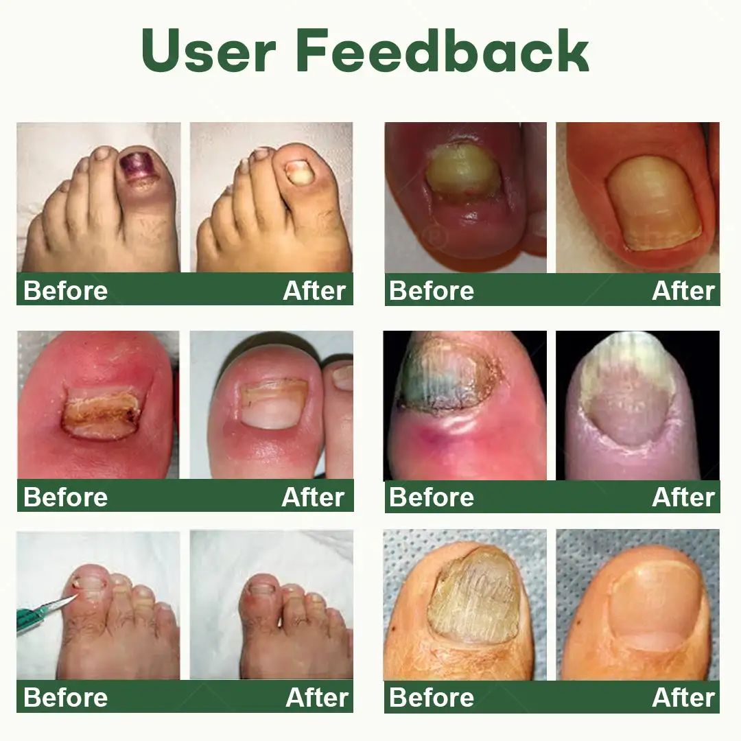 Dobshow® Nail Fungus Renewal Gel