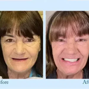 TrueEase™ Dentures