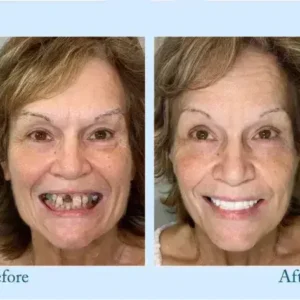 TrueEase™ Dentures