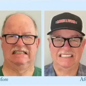TrueEase™ Dentures