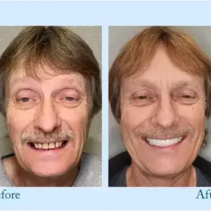 TrueEase™ Dentures
