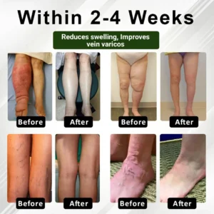 Zakdavi™ FluidEase Leg Therapy Edema Cream