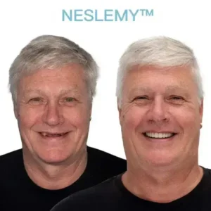 NESLEMY™ GelFit Dentures