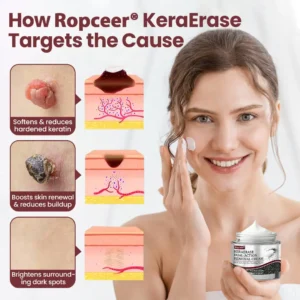 𝐑𝐨𝐩𝐜𝐞𝐞𝐫® KeraErase Dual-Action Renewal Cream