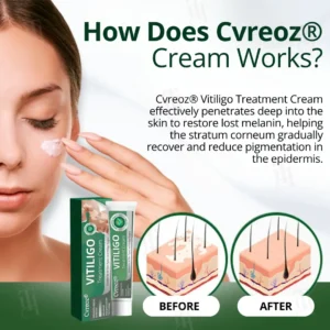 Cvreoz® Vitiligo Treatment Cream