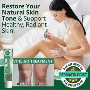 Cvreoz® Vitiligo Treatment Cream