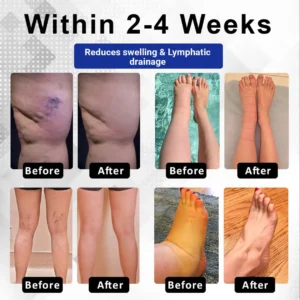 ODEIUN™ VenoPen Easy Drainage TENS Pen