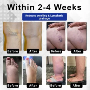 ODEIUN™ VenoPen Easy Drainage TENS Pen