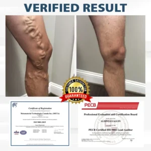 ODEIUN™ VenoPen Easy Drainage TENS Pen