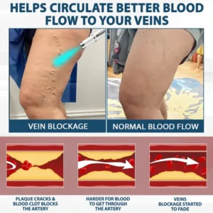 ODEIUN™ VenoPen Easy Drainage TENS Pen