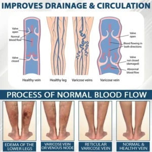 ODEIUN™ VenoPen Easy Drainage TENS Pen