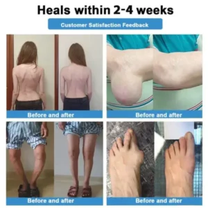 Skavix® Nano-Microneedle Joint Patch