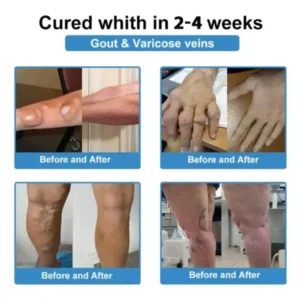 Skavix® Nano-Microneedle Joint Patch