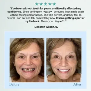 Yagoo® 🦷Advanced Customized Full Denture Set🦷 (🔥10,000+ Sold In Last 30 Day)