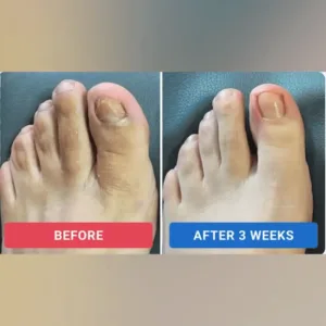 FungGone™ – Nail Repair Patches